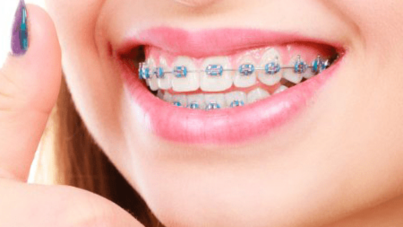 braces-1