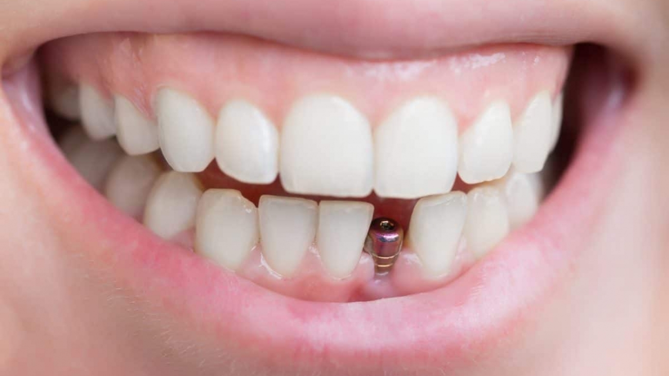 dental-implants-1200x800