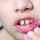 mouth-ulcer