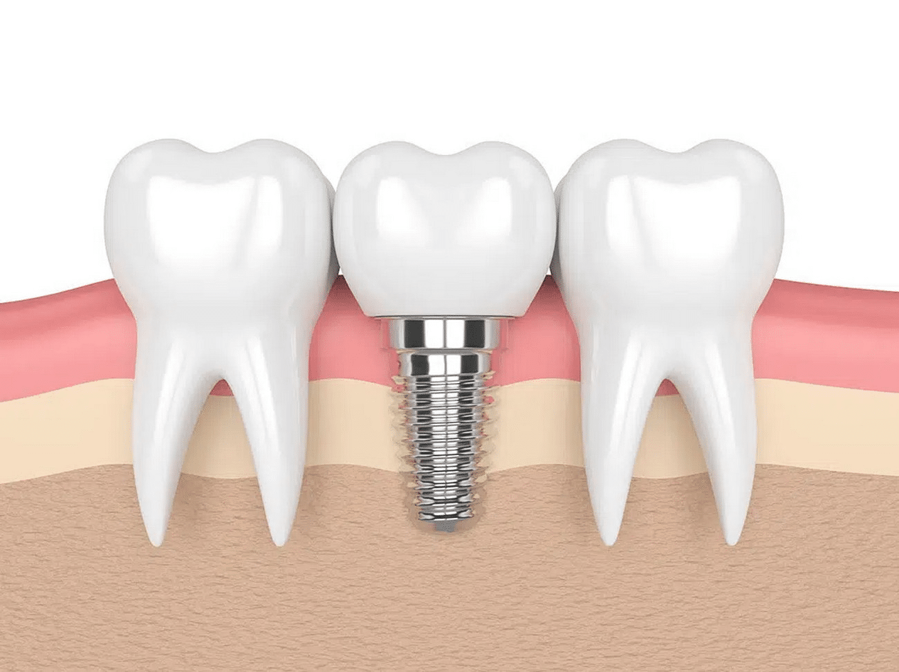 ایمپلنت دندان جایگذاری شده