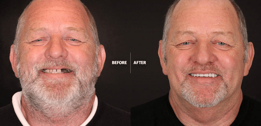 قبل و بعد قراردادن دندان