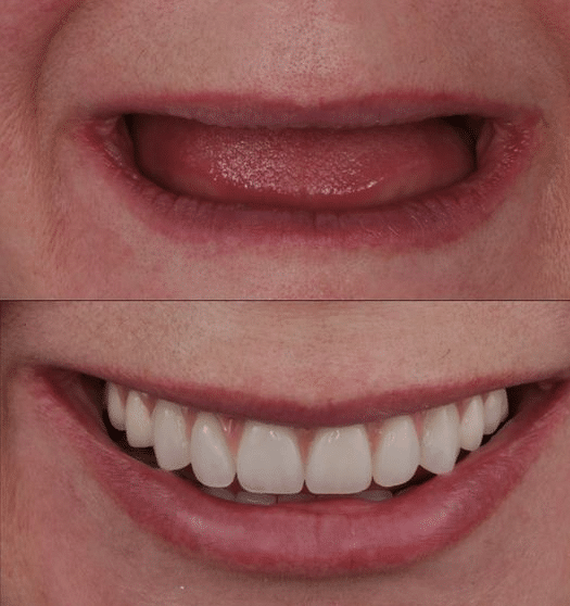 قبلو بعد از ایمپلنت دندان