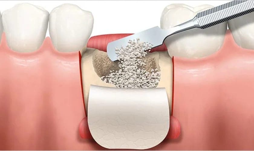 تزریق پودر استخوان در لثه